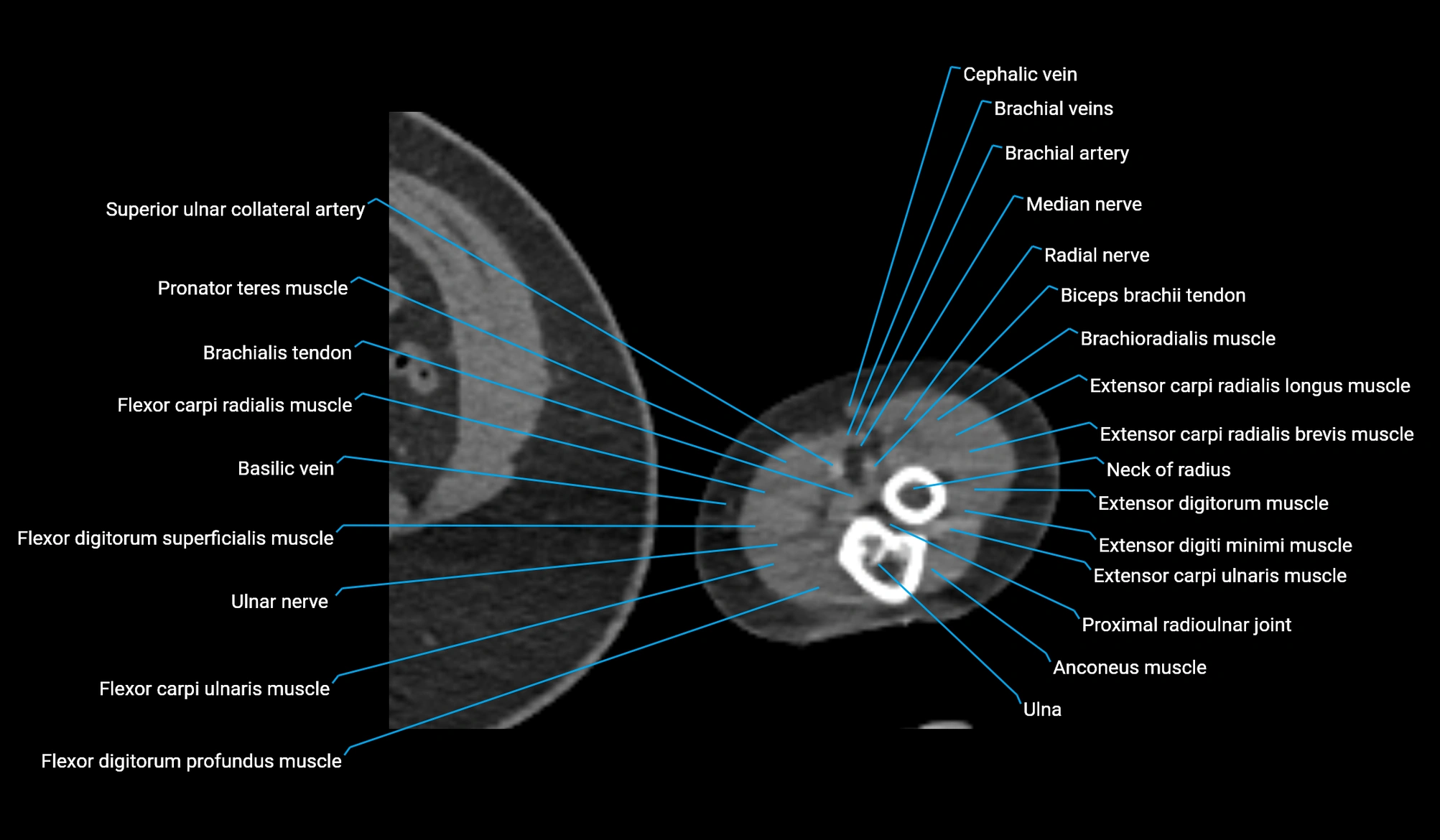 CT upper arm axial  cross sectional anatomy labelled radiology image -00412.webp